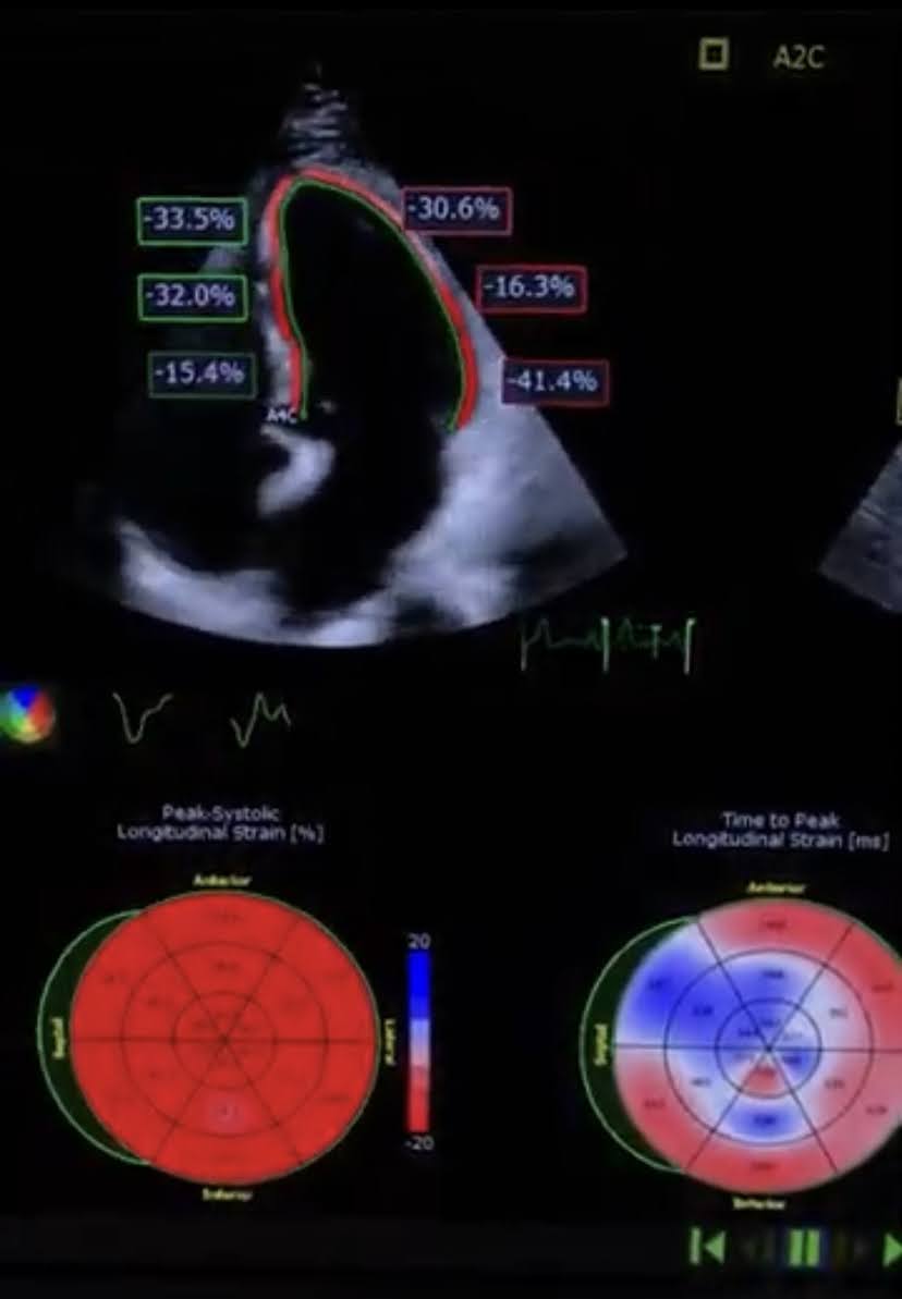 Ecocardiograma Strain Clinicor Busato